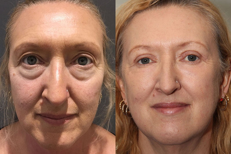 blepharoplasty before and after | Ptosis Surgery in London